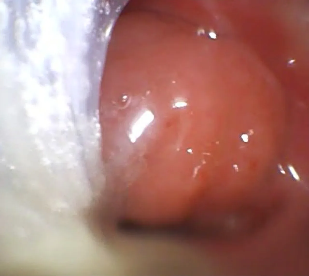 Imagem representativa de Adenoidectomia