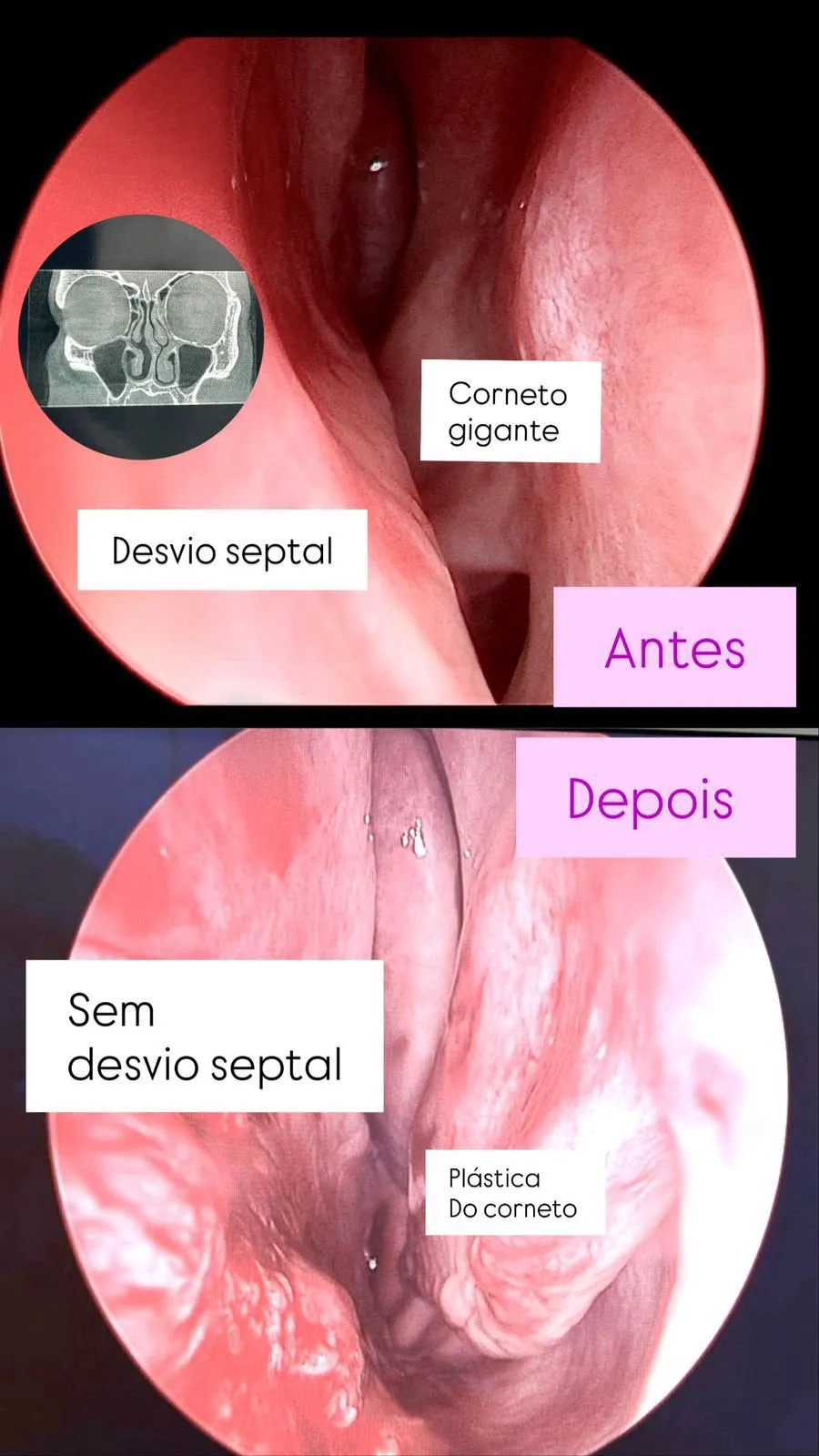 Imagem representativa de Septoplastia