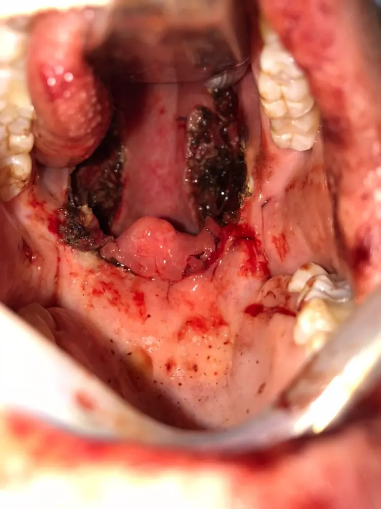 Imagem representativa de Faringoplastia Lateral