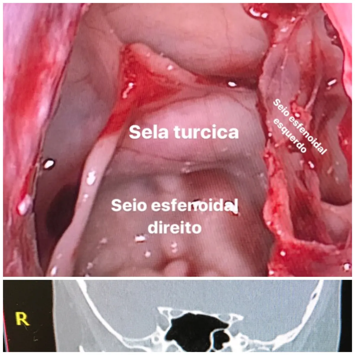 Imagem representativa de Cirurgia endoscópica nasal